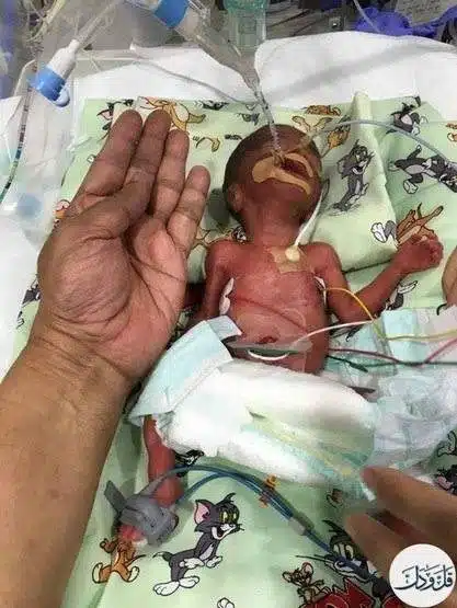 وُلد في الإمارات.. طفل بحجم الكف ويزن 580 جراما فقط