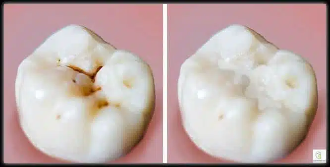 ممارسات شائعة تفسد الأسنان