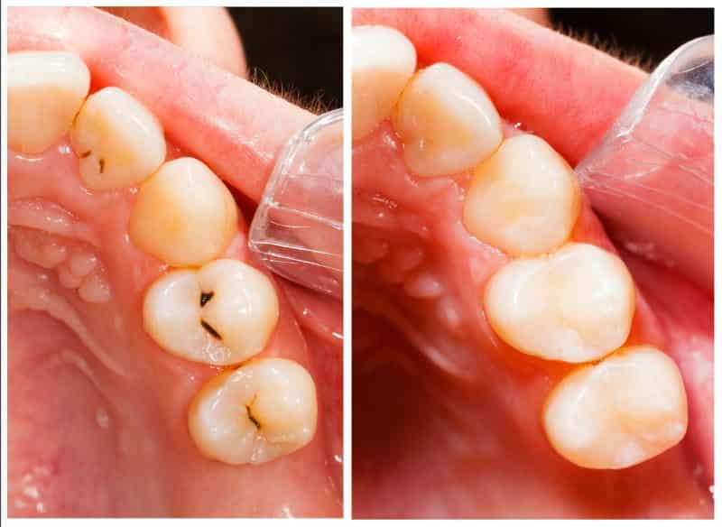 كيف تعالج تسوس الأسنان بطرق طبيعية وبسيطة؟