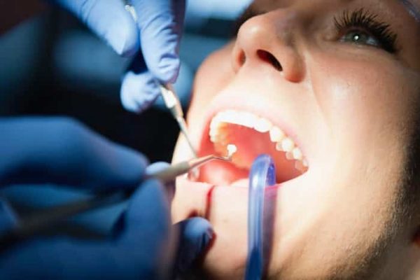 دراسة صادمة: حشو الأسنان قد يؤدي إلى التسمم بالزئبق!