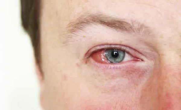 العين الوردية.. أسباب وعلاجات التهاب الملتحمة المزعج