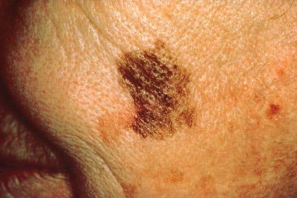 للاكتشاف المبكر.. 5 علامات لسرطان الجلد