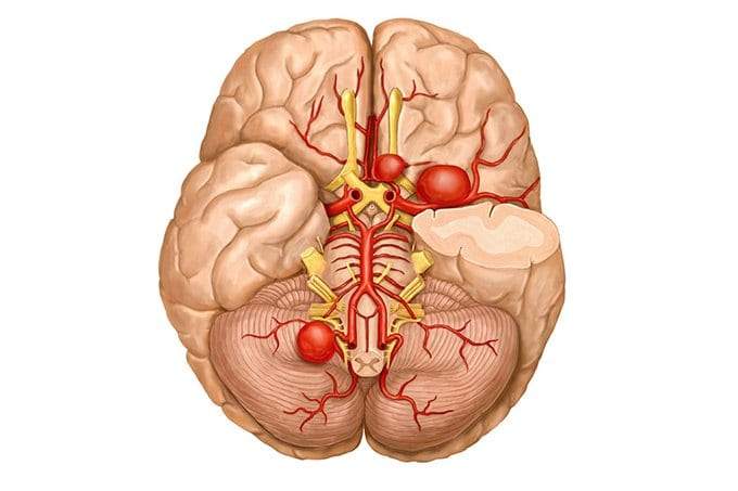 تمدد الأوعية الدموية في الدماغ.. الأسباب وأهم الأعراض