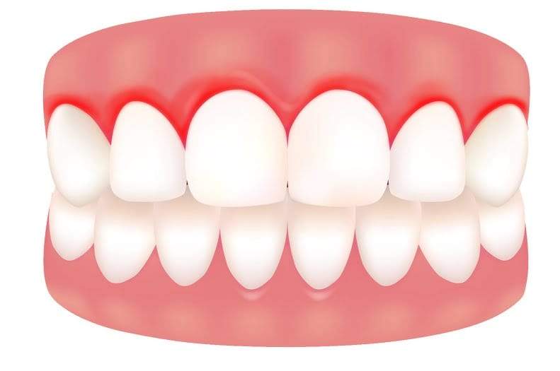 نقص فيتامين سي c يسبب نزيف اللثة والأسنان