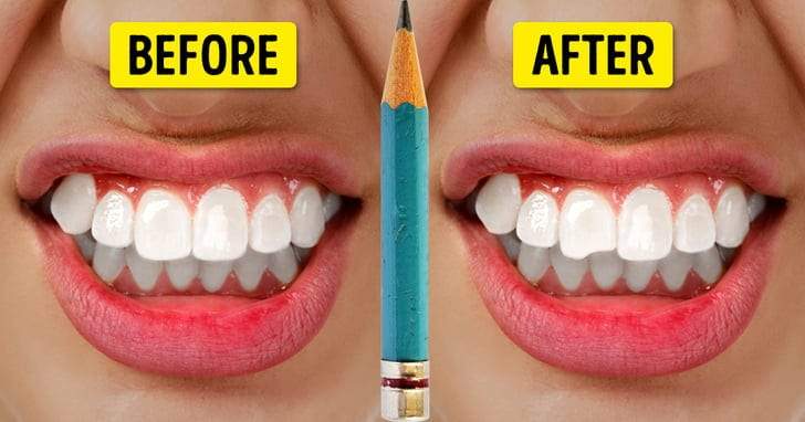 أخطاء شائعة ترتكب في حق الأسنان