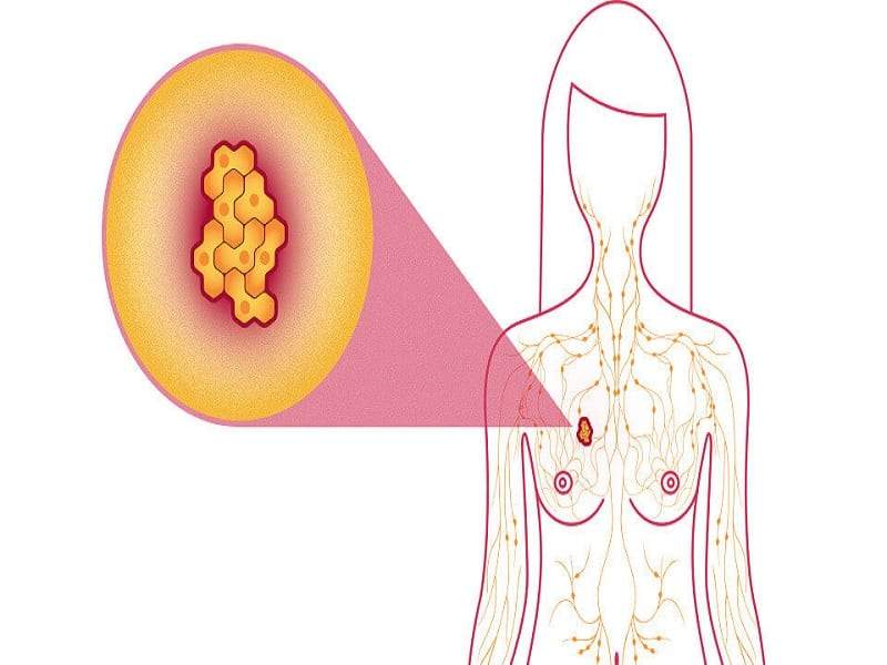 سرطان الثدي قد يحدث بسبب طفرة جينية وراثية أو بسبب نمط حياة خاطئ