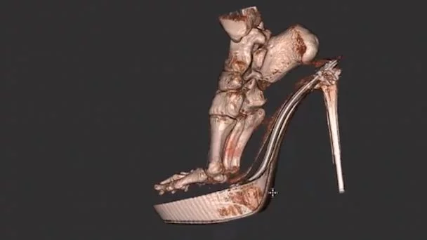 أضرار أحذية الكعب العالي.. كيف تصيب أغلب مناطق الجسم؟