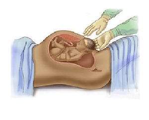 الولادة القيصرية.. فوائدها وخطورتها على الأم والجنين
