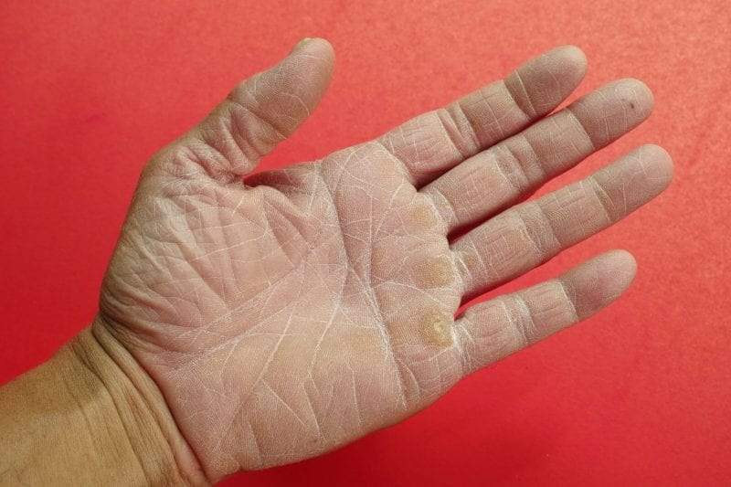 طرق التخلص من جفاف اليدين بسبب المطهرات