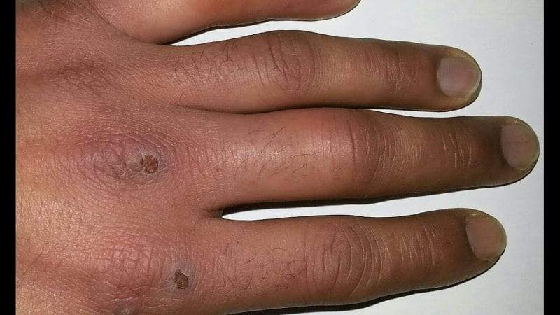 علاج تورم الأصابع