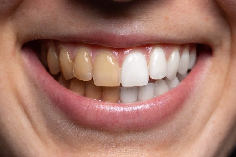 عادات شائعة يمكنها إفساد شكل الأسنان سريعا