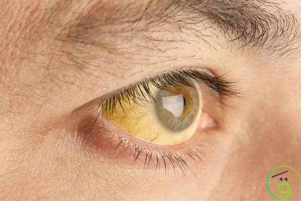 أعراض الاكتئاب على العين.. وهل تكشف عينك إصابتك بالاكتئاب؟