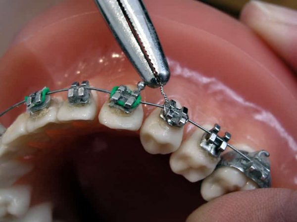 مميزات وعيوب تقويم الأسنان