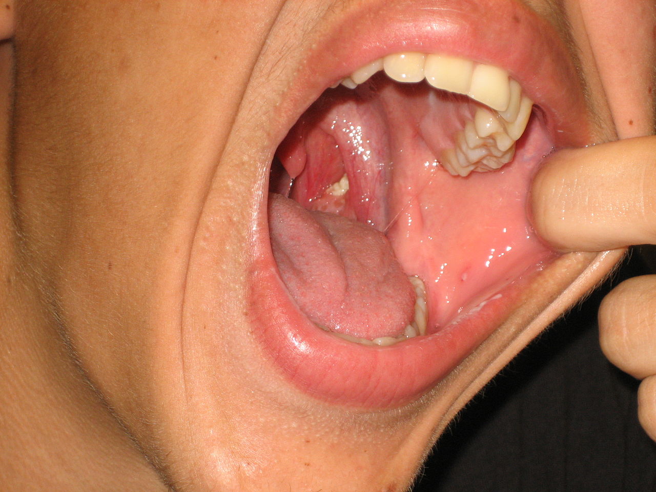 طرق-علاج-أمراض-الفم-المختلفة،-آكلة-الفم،-القروح-الباردة،-الصماخ،-قرحة-كانكر