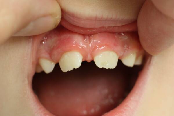 علاج ألم الأسنان عند الأطفال 6 سنوات