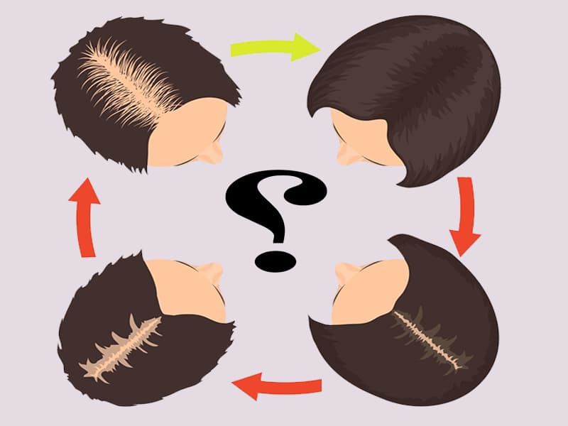 علاج فراغات الشعر الأمامية للنساء طبيعيًا