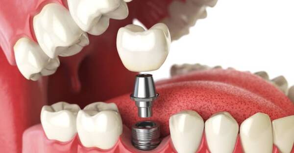 ما هي عملية زراعة الأسنان