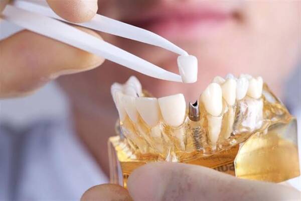 ما هي عملية زراعة الأسنان