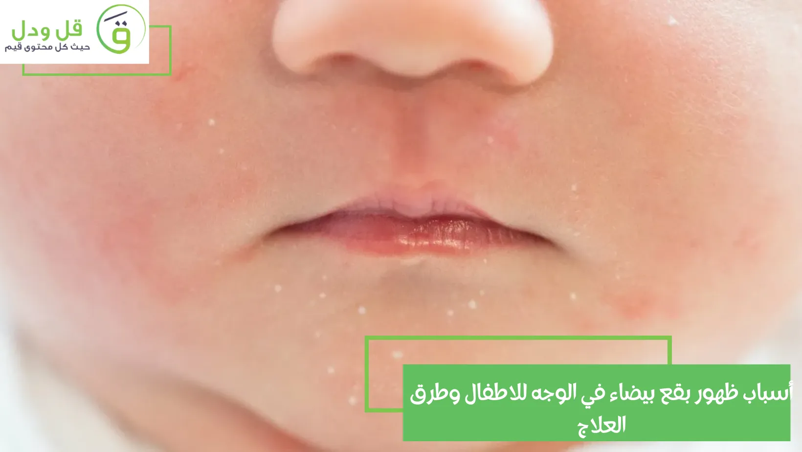 أسباب ظهور بقع بيضاء في الوجه للاطفال وطرق العلاج
