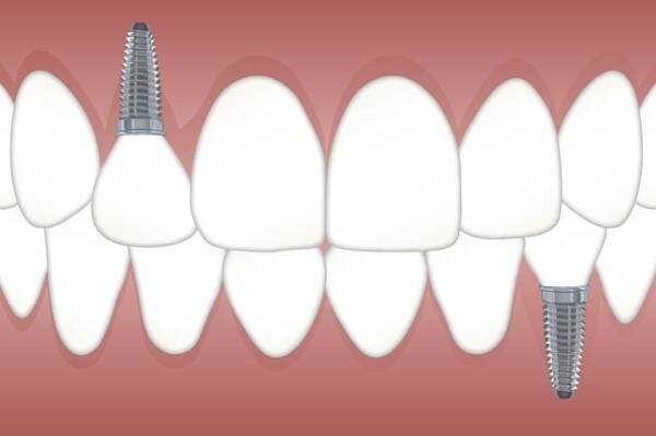 زراعة الأسنان أفضل الخيارات العلاجية.. فهل لها عيوب؟