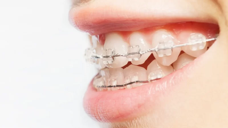 تقويم الأسنان الشفاف 