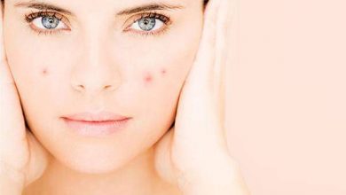 هل تعاني من حب الشباب إذن أنت محظوظ