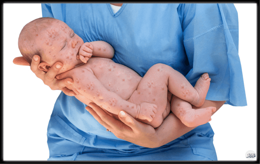 أخطر أمراض الأطفال.. التي اختفت الآن