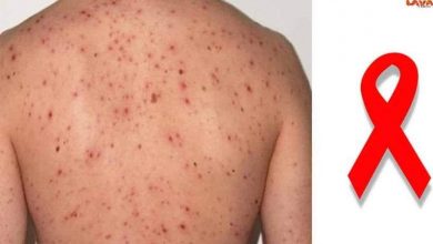 6 علامات مبكرة لكشف فيروس نقص المناعة المؤدي للإيدز