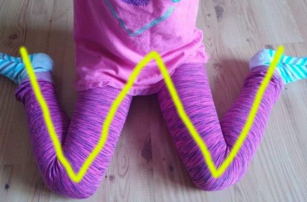 وضعية الجلوس "W" للأطفال.. الخطورة وطرق العلاج