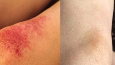 كل ما يجب أن تعرفه عن التهاب الأوعية الدموية