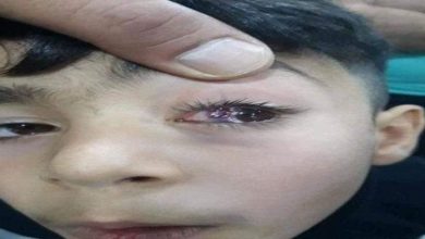 تحذير للآباء والأمهات.. هل يؤدي اللعب مطولا بالهاتف لانفجار أوردة العين؟