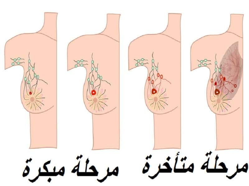 سرطان الثدي يمر بأربعة مراحل تختلف فيها طريقة العلاج