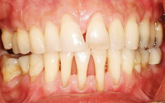 انحسار اللثة.. أسباب وعلاجات طبيعية