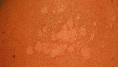 النخالية المبرقشة.. أسباب وعلاجات أزمة الجلد المزعجة