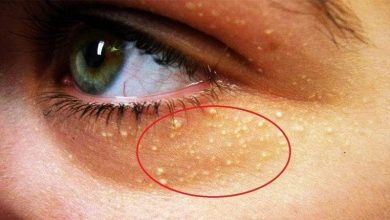 اللويحة الصفراء.. علاجات طبيعية لبثور العين المزعجة