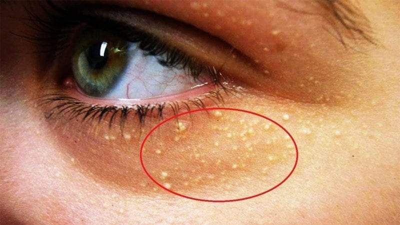 اللويحة الصفراء.. علاجات طبيعية لبثور العين المزعجة