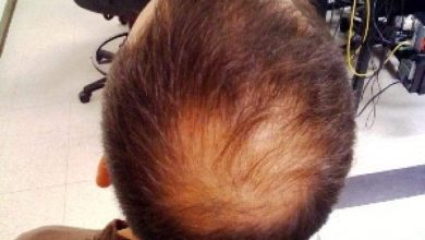 علاج الثعلبة نهائيا