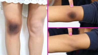 علاجات طبيعية لأزمة سواد الركبة والكوع