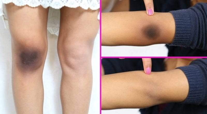 علاجات طبيعية لأزمة سواد الركبة والكوع