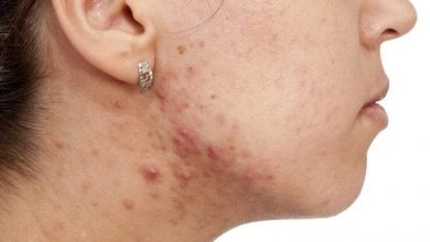 علامات تكشف المعاناة من نقص الزنك في الجسم