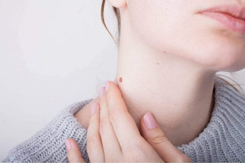 طريقة علاج الثالول