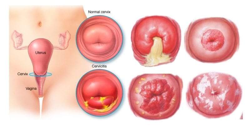 أعراض قرحة الرحم علاج قرحة الرحم اسباب قرحة الرحم 