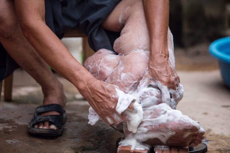 داء الفيل.. عندما تتضخم أعضاء الجسم بسبب بعوضة داء الفيل