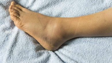 تورم الكاحل.. أسباب متنوعة وعلاجات متعددة