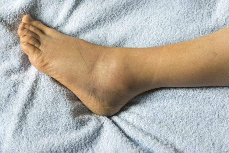 تورم الكاحل.. أسباب متنوعة وعلاجات متعددة
