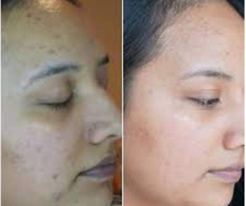 التقشير الماسي