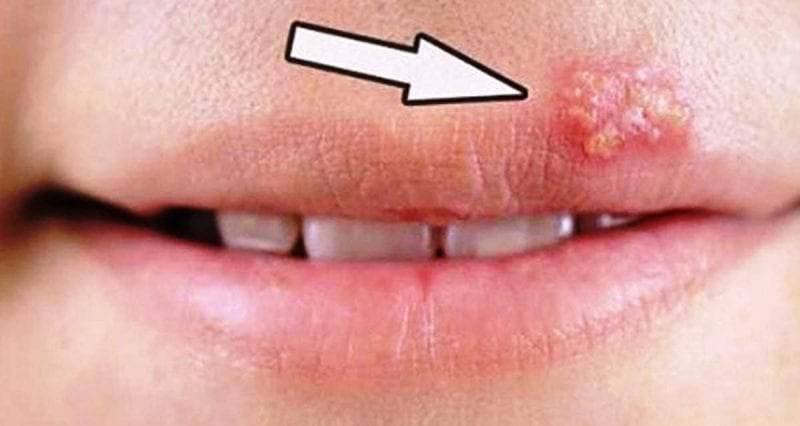 علاج الهربس الفموي