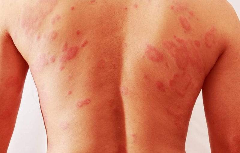 حساسية الأرتكاريا ما أسبابها وكيف يمكن التخلص منها قل ودل