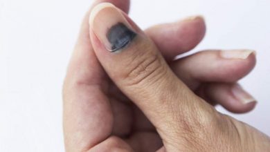 علاج احتباس الدم تحت الأظافر