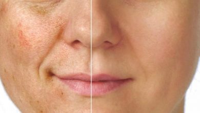 7 طرق طبيعية لمواجهة تصبغ الوجه المزعج